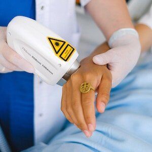 laser treatment of wart symptoms